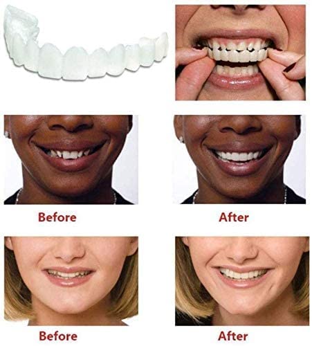 Snap on Smile Veneers - Adjustable Snap on Dentures - Smilo™